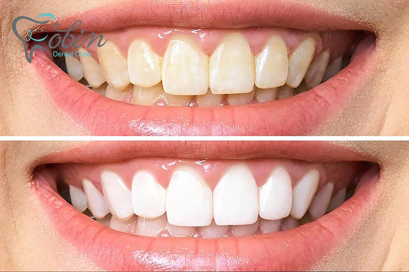 بیلچینگ دندان در زیبایی دندان ها بسیار موثر است.